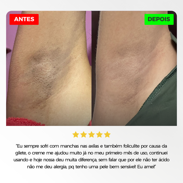 Duo para Manchas Íntimas e Foliculite Mizz